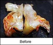 artery before treatment