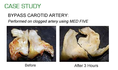 Med Five Case Study : Bypass Carotid Artery Performed on clogged artery using Med Five Full System